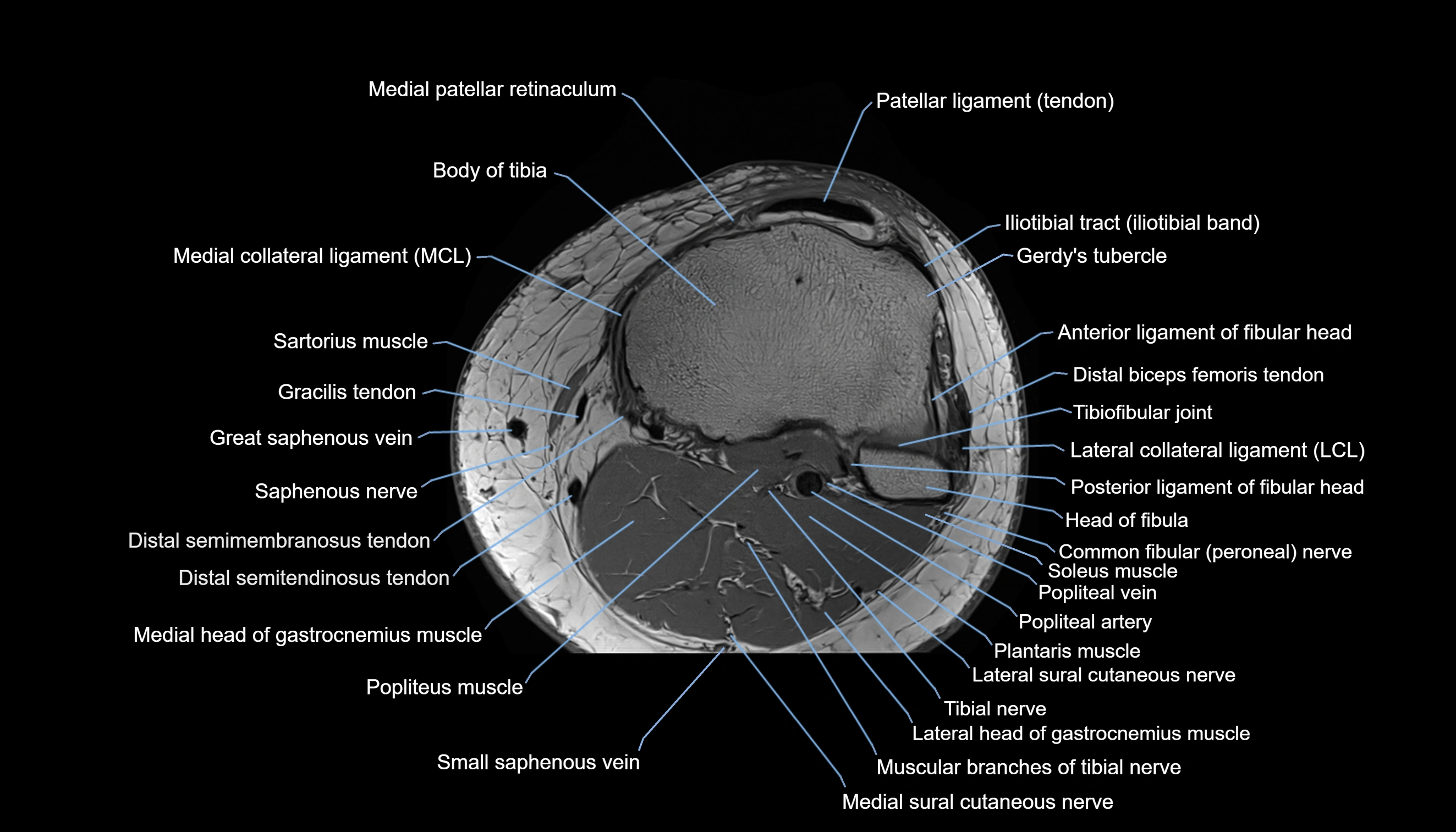 MRI knee  axial cross sectional anatomy 3T radiology  image-img-00001-00039.webp